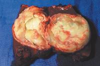 Abbildung 3: Echinokokkus - Leber