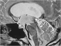 Abbildung 1: Hydrozephalus beim  Erwachsenen