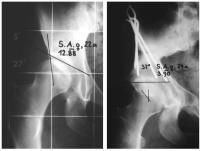 Abbildung 12: Hüftgelenk
