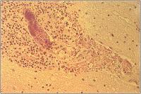 Abbildung 2: Septischer Embolus