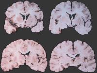 Abbildung 5: Temporallappenenzephalitis