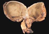 Abbildung 6: Holoprosenzephalie