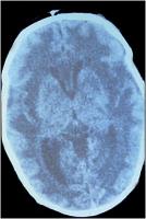 Abbildung 8: Herpes simplex - Enzephalitis