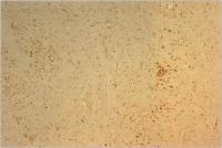 Abbildung 9: Herpes simplex - Hirnstammenzephalitis