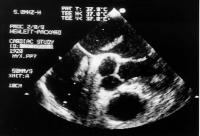 Figure 1: Pseudomyxom in beiden Atrien