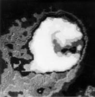 Figure 1: Ventrikuläre Tachykardie