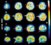 Abbildung 11: Temorallappenenzephalitis - Läsionen