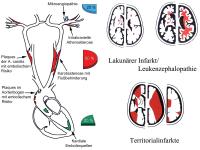 Abbildung 1: Ischämischer Schlaganfall - Ursachen