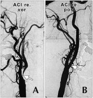 Abbildung 2: Arteria carotis - Stenose - Stent