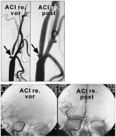 Abbildung 3: Arteria carotis - Stenose - Stent