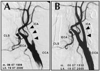 Abbildung 4A-B: Arteria carotis - Stenose - Stent