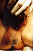 Abbildung 2: Fournier'sche Gangrän