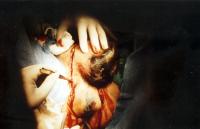 Abbildung 3: Fournier'sche Gangrän