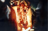 Abbildung 5: Fournier'sche Gangrän