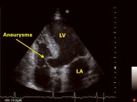 Abbildung 1: Interventrikuläres Septum - Aneurysma