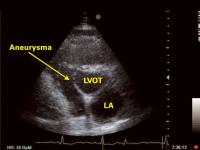 Abbildung 2: Interventrikuläres Septum - Aneurysma