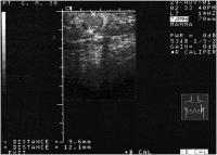 Abbildung 1: Mammographie - Knoten