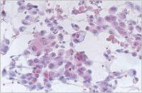 Abbildung 3: Feinnadelpunktion - Schilddrüsenkarzinom