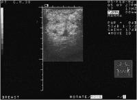 Abbildung 4: Mammographie - Knoten