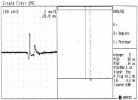 Abbildung 1: Einzelfaserelektromyographie