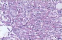 Abbildung 5: Stanzbiopsie - Karzinomgewebe