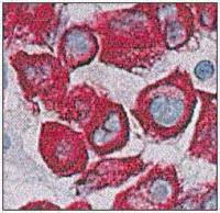 Abbildung 6a: Stanzbiopsie - Karzinomgewebe