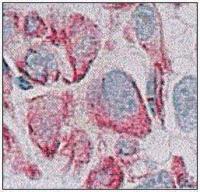 Abbildung 6b: Stanzbiopsie - Karzinomgewebe