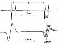 Abbildung 2: Einzelfaserelektromyographie