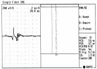 Abbildung 4: Einzelfaserelektromyographie - Myasthenia gravis