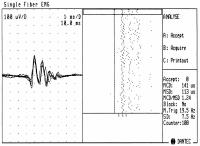 Abbildung 5: Einzelfaserelektromyographie - ALS