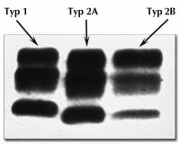 Abbildung 2: Spongiforme Enzephalopathie - Prionprotein-Glykoformen