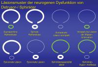 Abbildung 1: Neurogene Dysfunktion - Läsionsmuster