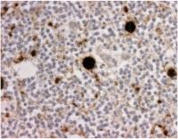 Abbildung 5: Spongiforme Enzephalopathie - Kuru - Prionprotein