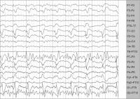 Abbildung 1: EEG - PLEDs