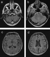 Abbildung 1a-d: Primäre Lateralsklerose - Degeneration - Marklagerdefekte