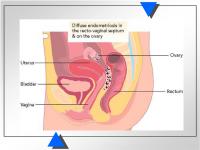 Abbildung 2: Endometriose