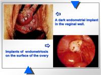 Abbildung 4: Endometriose