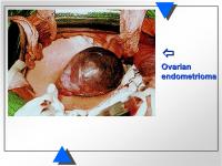 Abbildung 5: Endometriose