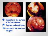 Abbildung 10: Endometriose