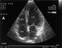 Abbildung 3a: Hepatopulmonales Syndrom - Fallbericht