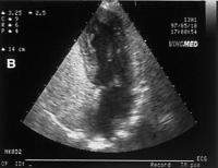 Abbildung 3b: Hepatopulmonales Syndrom - Fallbericht