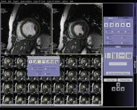 Abbildung 3: Kardiale Magnetresonanztomographie
