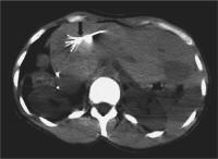 Abbildung 1: Radiofrequenzablation - Tumor