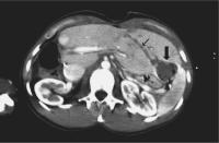 Abbildung 2: Radiofrequenzablation - Tumor