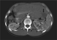 Abbildung 3: Radiofrequenzablation - Tumor