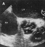 Abbildung 1-a: Aortenklappenstenose