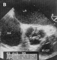 Abbildung 1-b: Aortenklappenstenose