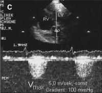 Abbildung 1-c: Aortenklappenstenose