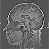 Abbildung 1: Epileptische Anfälle - intrathekale Fluoreszeinapplikation