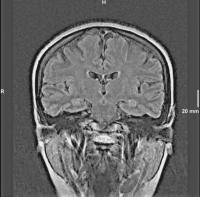 Abbildung 2: Epileptische Anfälle - intrathekale Fluoreszeinapplikation